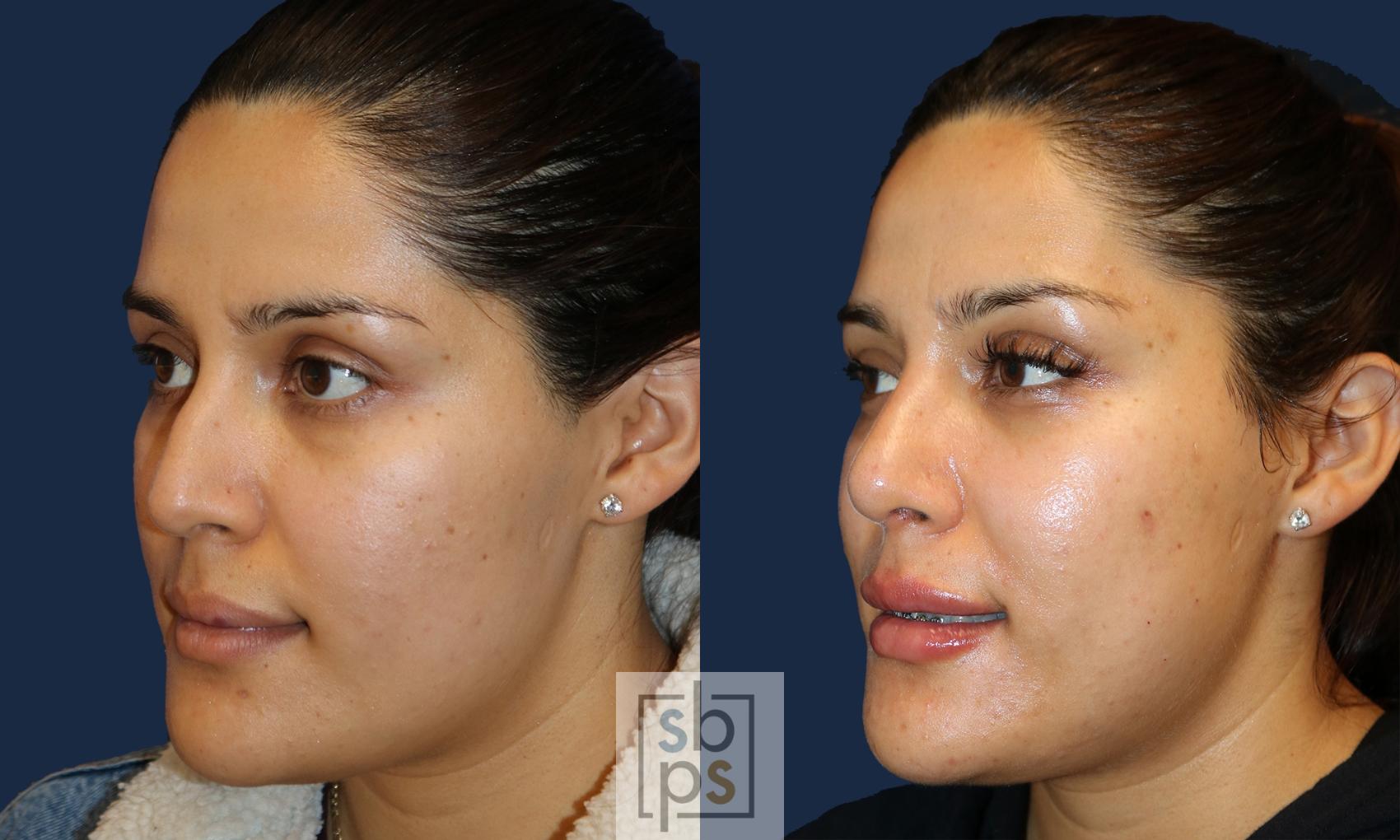 Before & After Nose Surgery (Rhinoplasty) Case 498 Left Oblique View in Torrance, CA