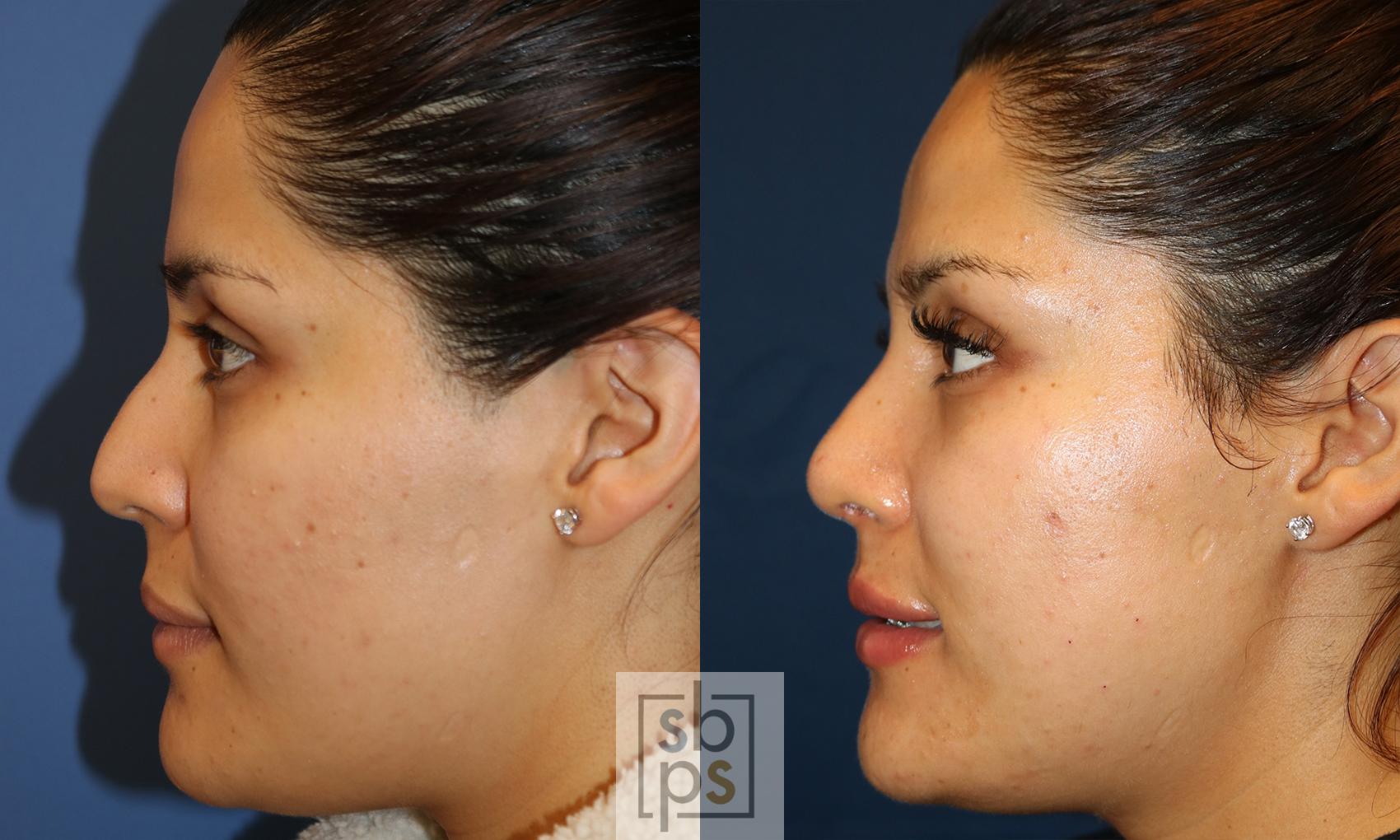Before & After Nose Surgery (Rhinoplasty) Case 498 Left Side View in Torrance & Los Angeles, CA, CA