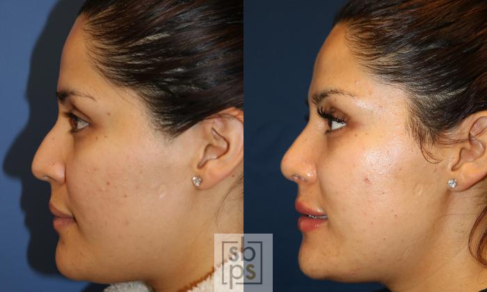 Before & After Nose Surgery (Rhinoplasty) Case 498 Left Side View in Torrance, CA