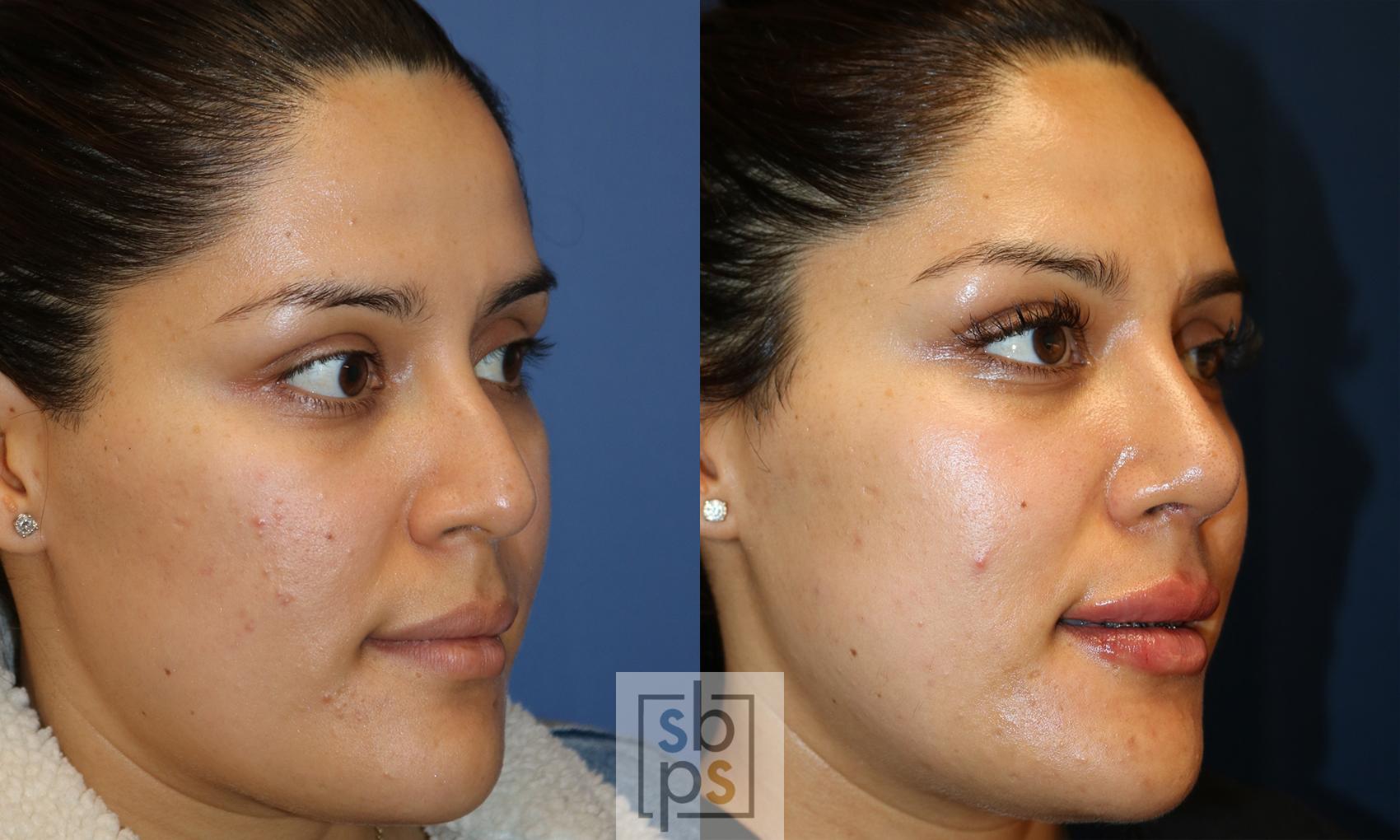 Before & After Nose Surgery (Rhinoplasty) Case 498 Right Oblique View in Torrance, CA