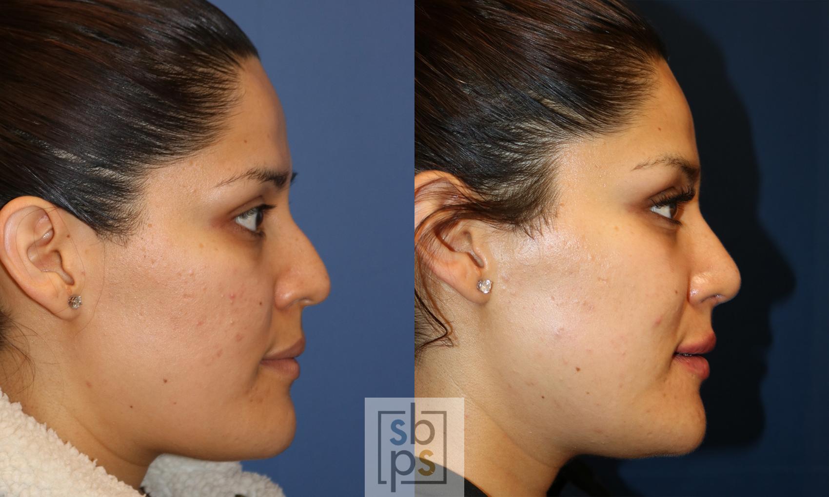 Before & After Nose Surgery (Rhinoplasty) Case 498 Right Side View in Torrance, CA