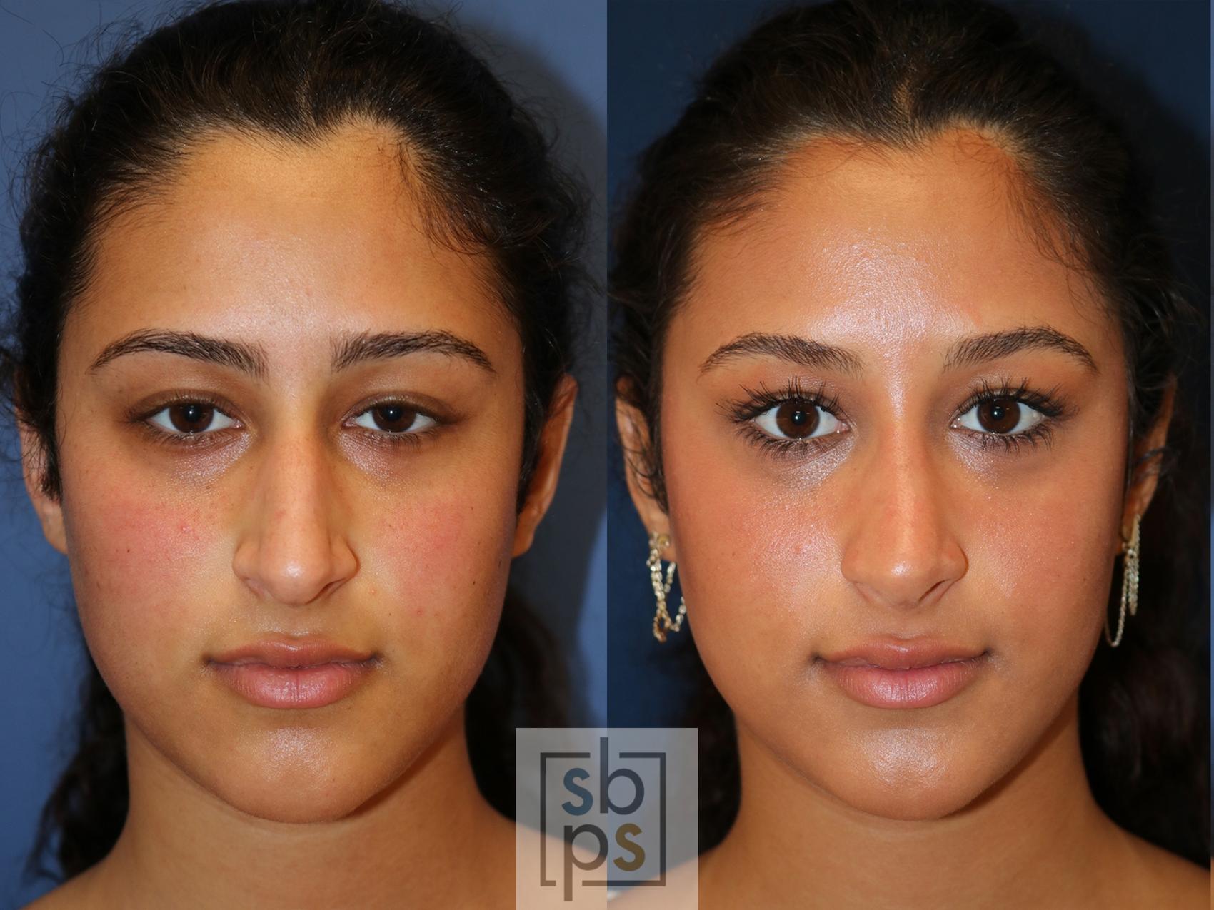 Before & After Nose Surgery (Rhinoplasty) Case 549 Front View in Torrance, CA