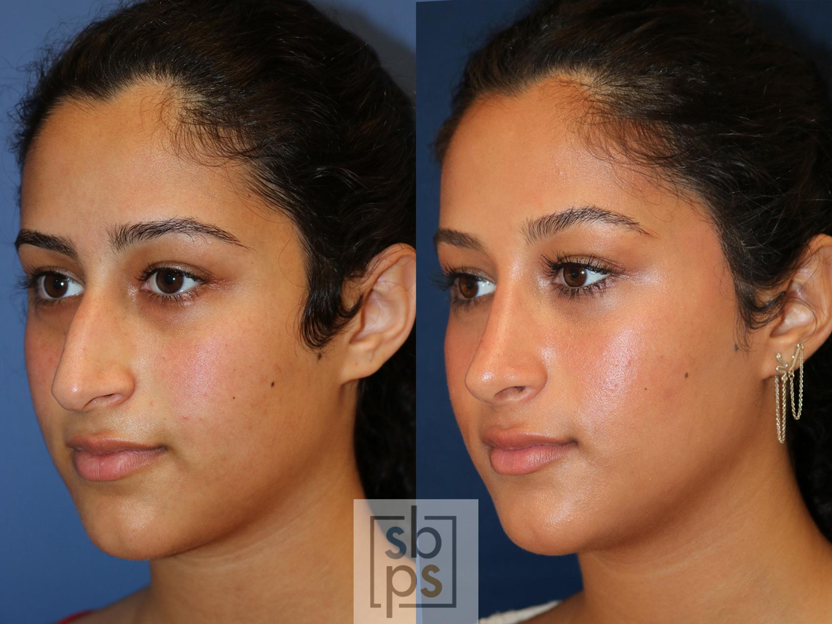 Before & After Nose Surgery (Rhinoplasty) Case 549 Left Oblique View in Los Angeles & Torrance, CA, CA