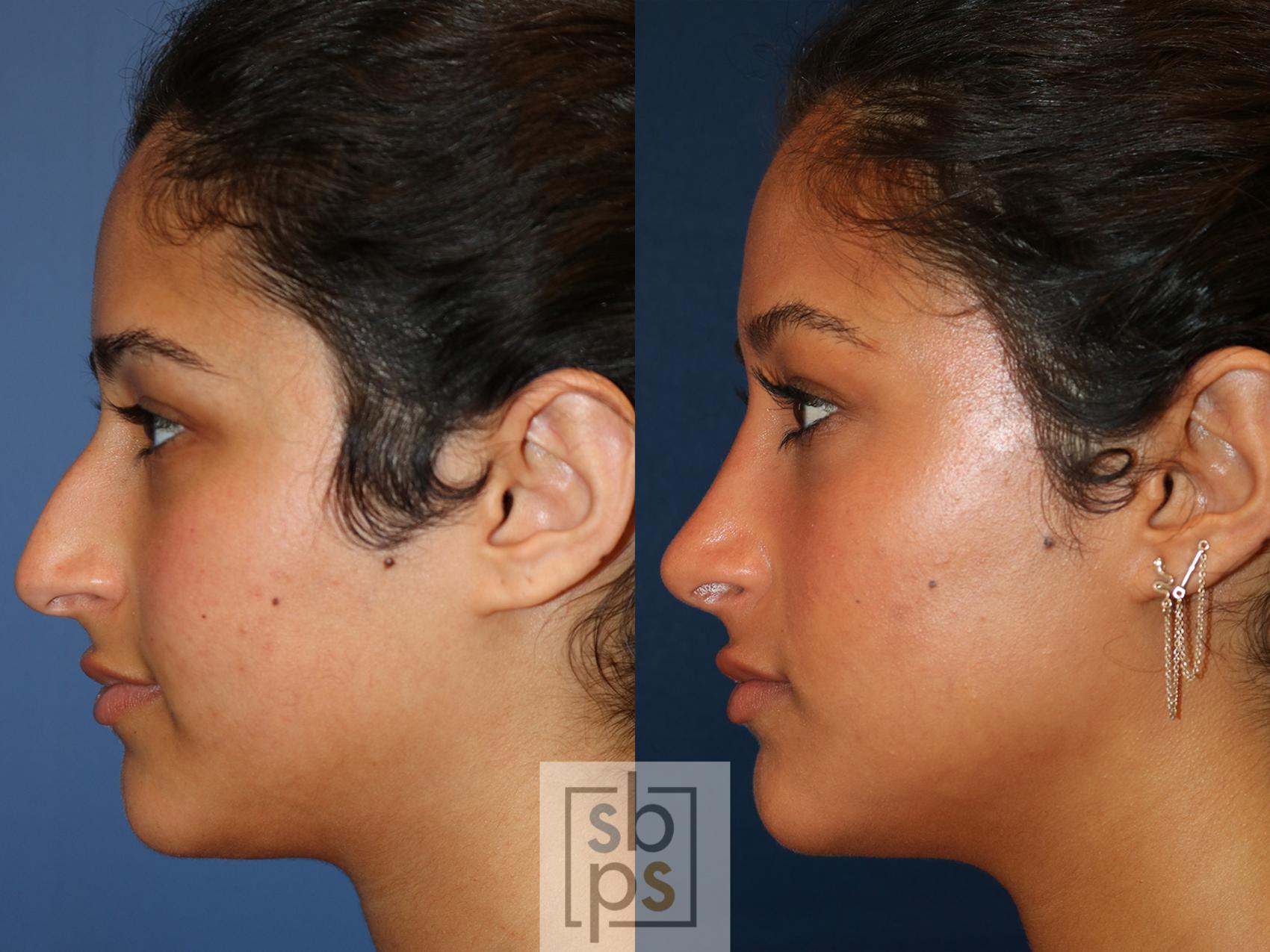 Before & After Nose Surgery (Rhinoplasty) Case 549 Left Side View in Torrance, CA