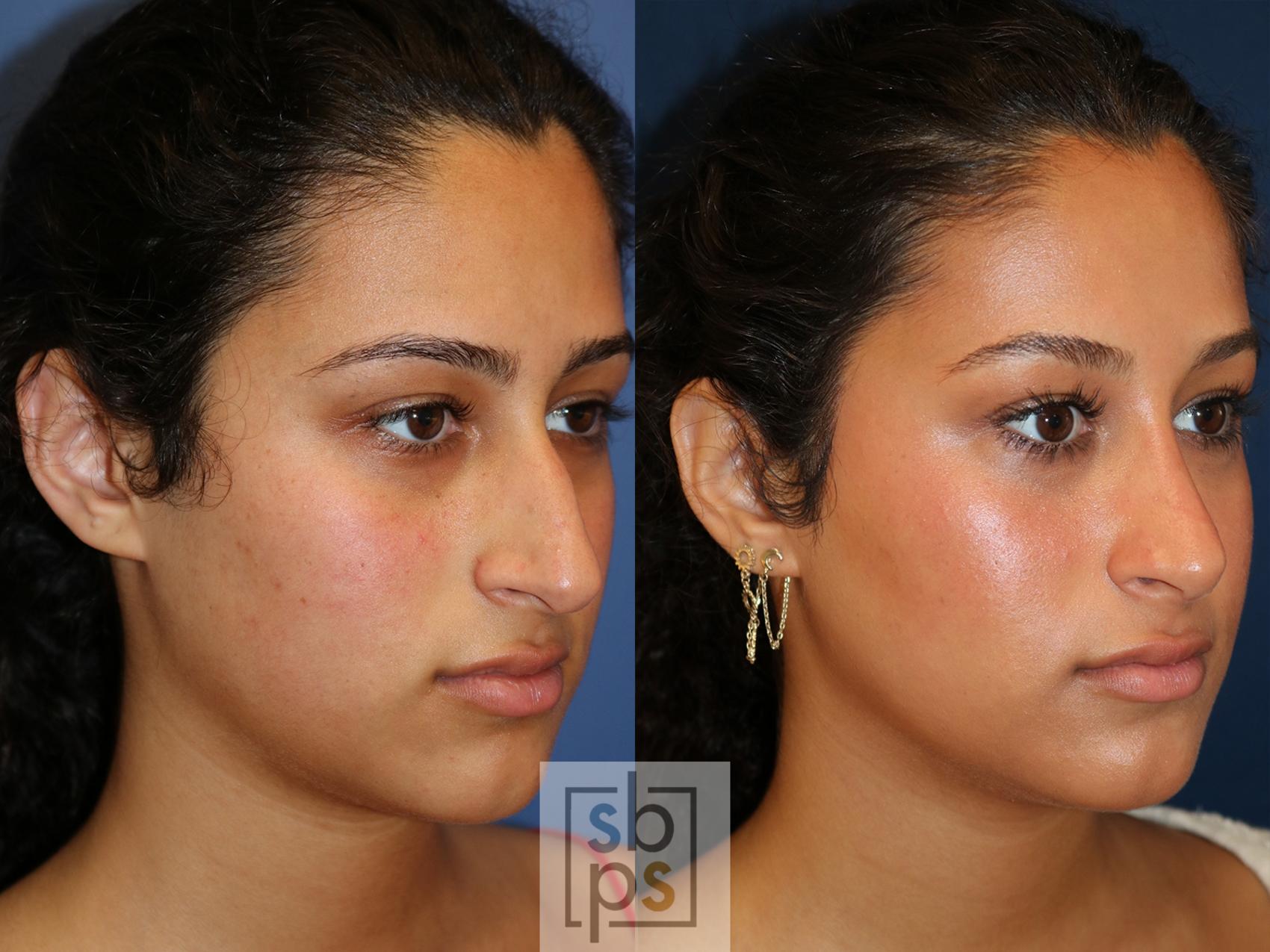 Before & After Nose Surgery (Rhinoplasty) Case 549 Right Oblique View in Torrance, CA