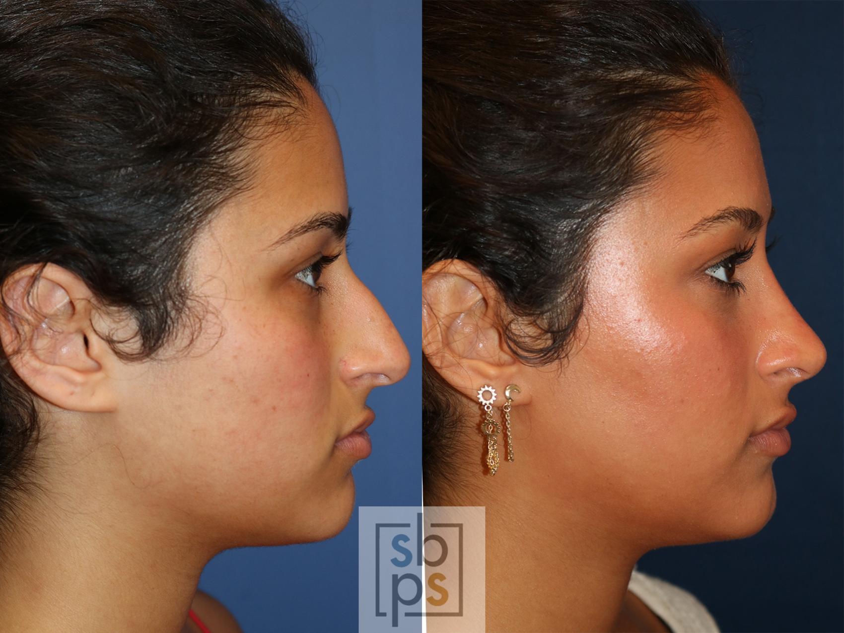 Before & After Nose Surgery (Rhinoplasty) Case 549 Right Side View in Torrance, CA