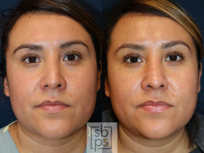 Before & After Nose Surgery (Rhinoplasty) Case 746 Front View in Los Angeles, Torrance & Long Beach, CA