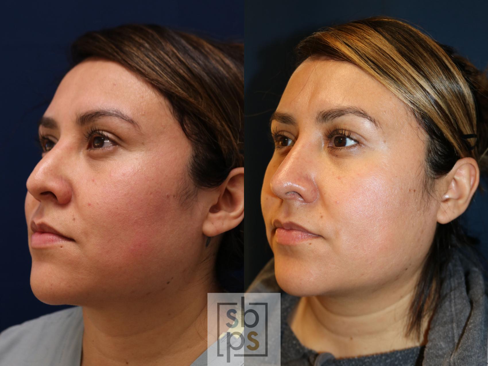 Before & After Nose Surgery (Rhinoplasty) Case 746 Left Oblique View in Los Angeles, Torrance & Long Beach, CA