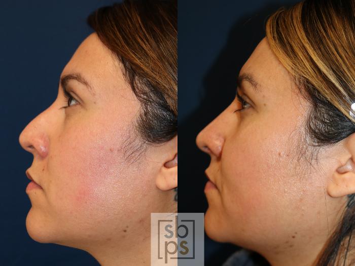 Before & After Nose Surgery (Rhinoplasty) Case 746 Left Side View in Los Angeles, Torrance & Long Beach, CA