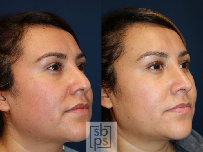 Before & After Nose Surgery (Rhinoplasty) Case 746 Right Oblique View in Los Angeles, Torrance & Long Beach, CA