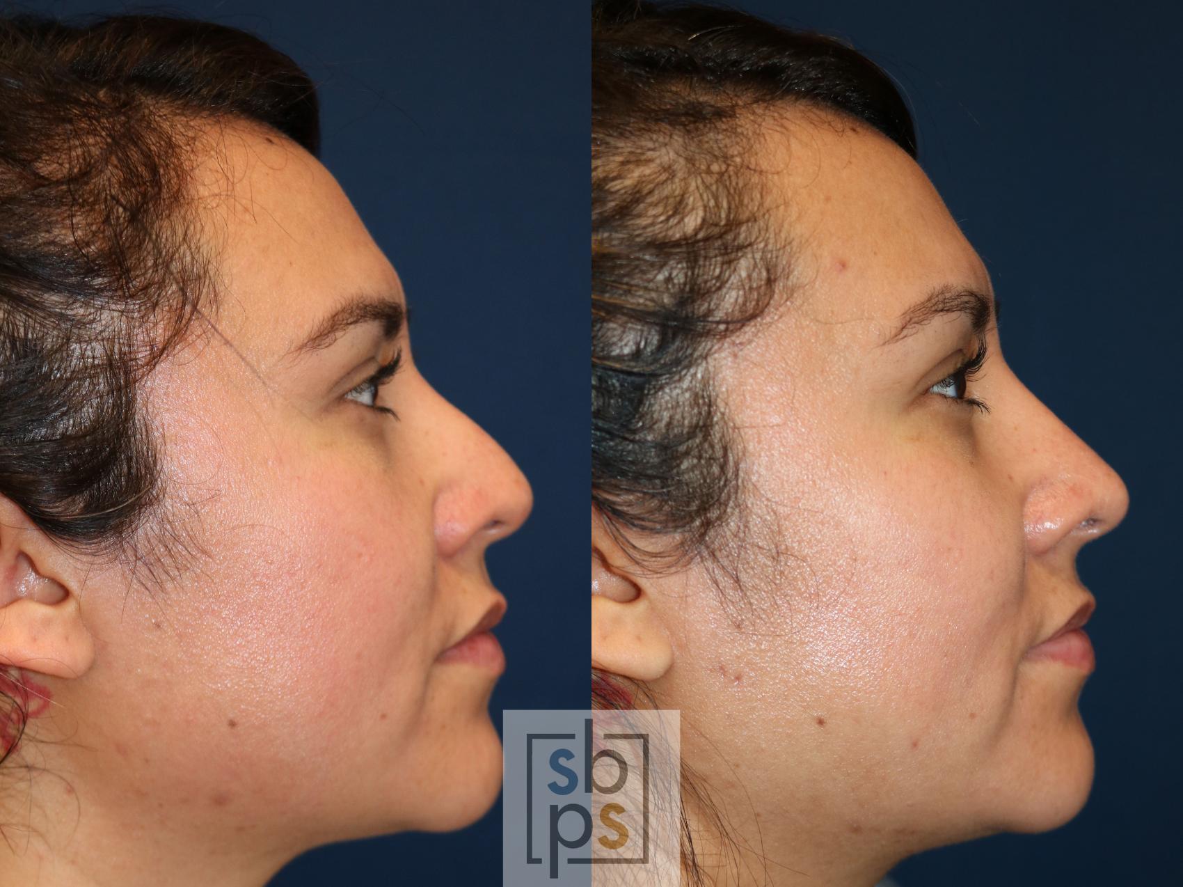 Before & After Nose Surgery (Rhinoplasty) Case 746 Right Side View in Los Angeles, Torrance & Long Beach, CA
