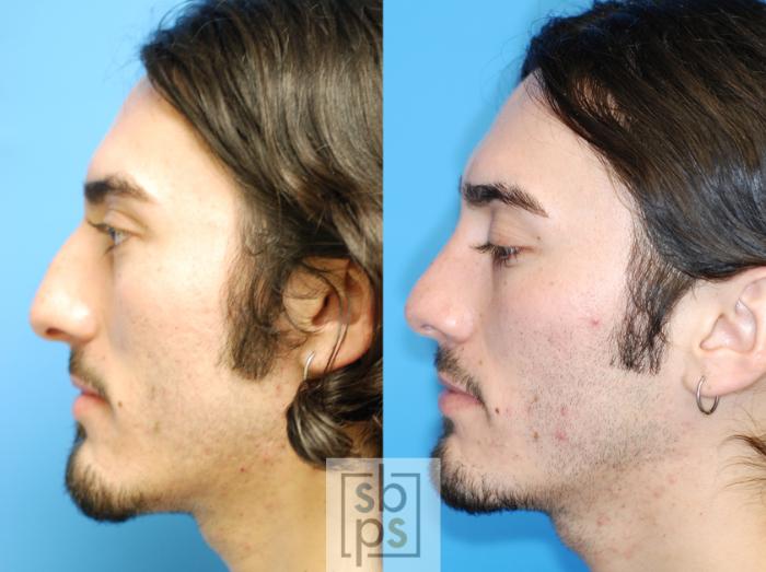 Before & After Nose Surgery (Rhinoplasty) Case 80 View #1 View in Torrance, CA