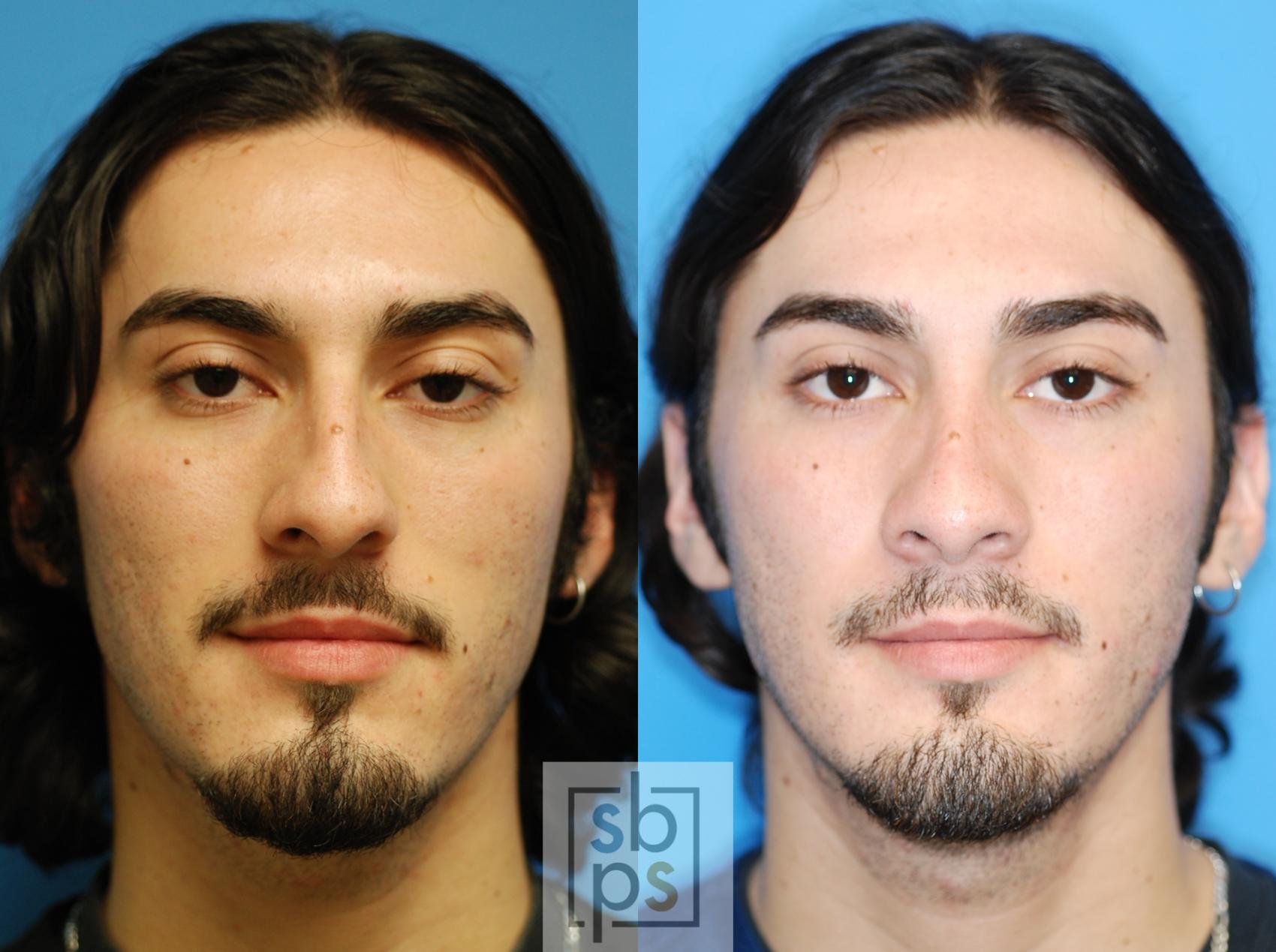 Before & After Nose Surgery (Rhinoplasty) Case 80 View #2 View in Torrance & Los Angeles, CA, CA