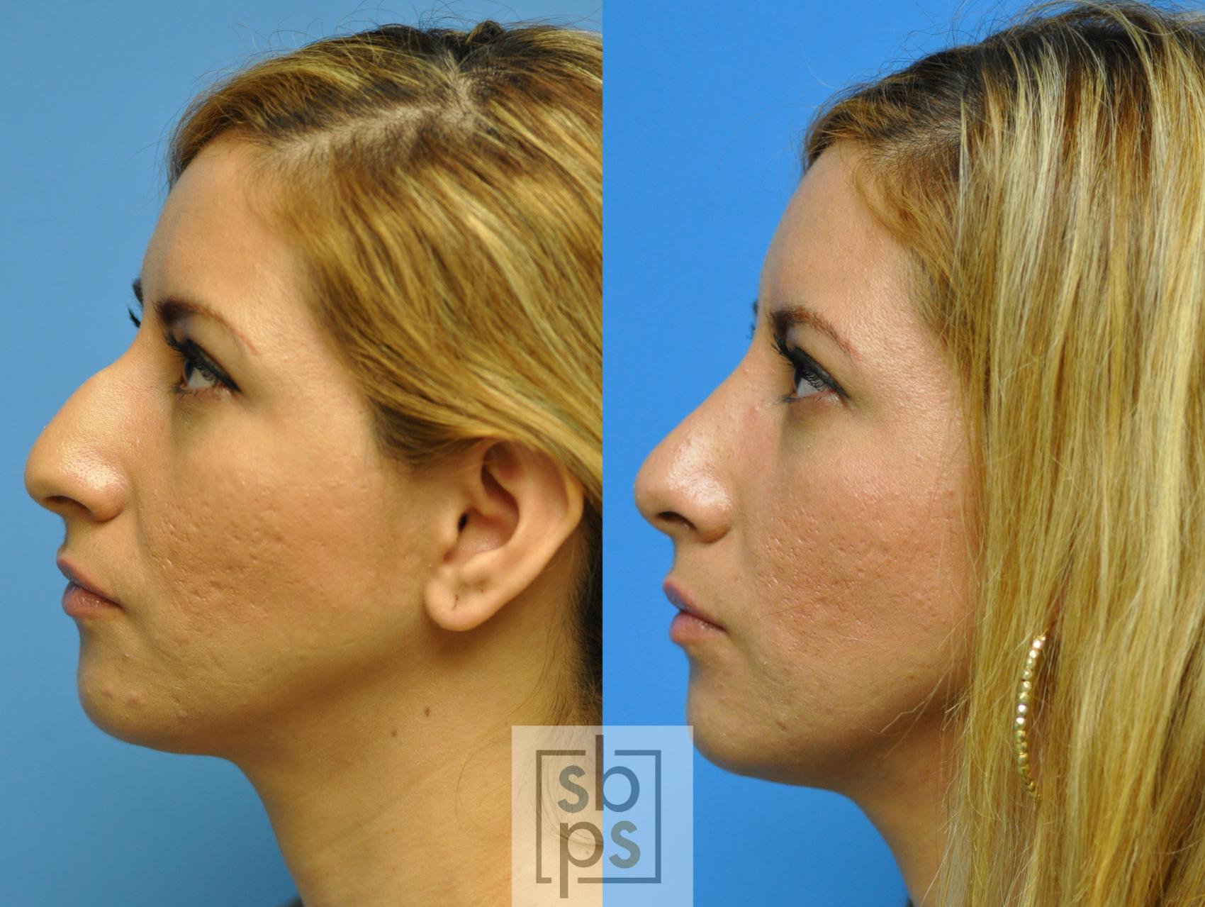 Before & After Nose Surgery (Rhinoplasty) Case 86 View #1 View in Torrance, CA