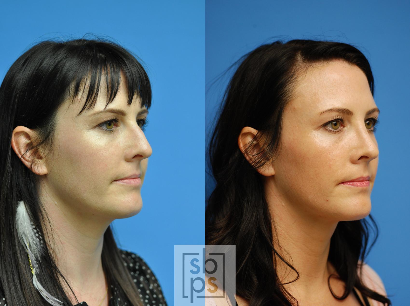 Before & After Nose Surgery (Rhinoplasty) Case 92 View #1 View in Torrance, CA
