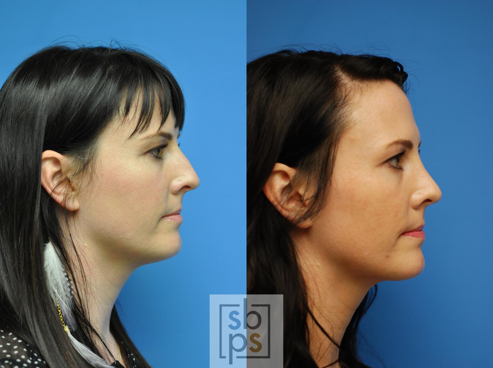 Before & After Nose Surgery (Rhinoplasty) Case 92 View #2 View in Torrance & Los Angeles, CA, CA