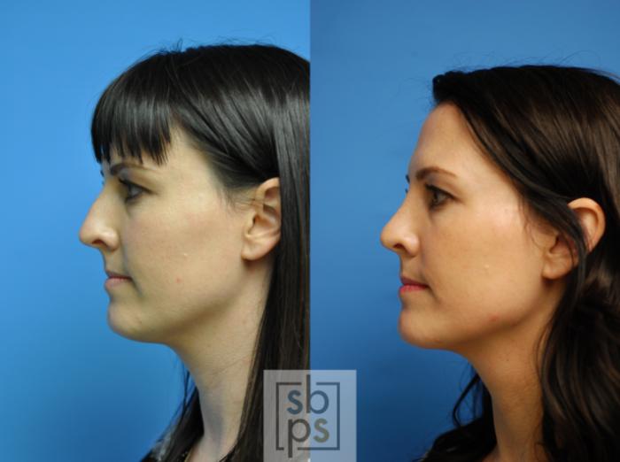 Before & After Nose Surgery (Rhinoplasty) Case 92 View #3 View in Torrance, CA