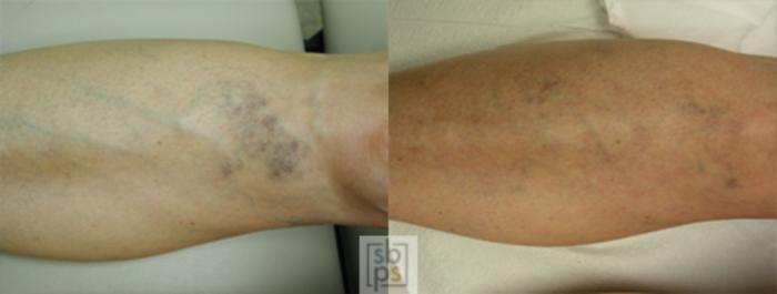 Before & After Sclerotherapy Case 29 View #1 View in Torrance, CA