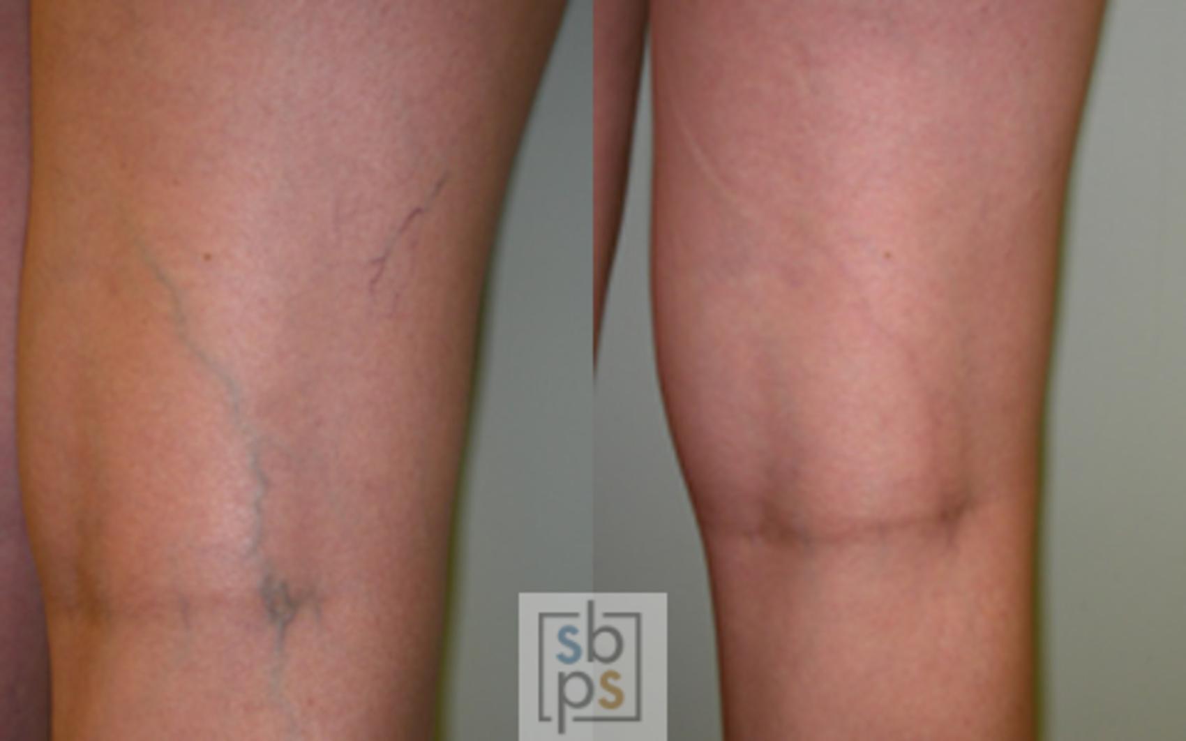 Before & After Sclerotherapy Case 30 View #1 View in Torrance, CA