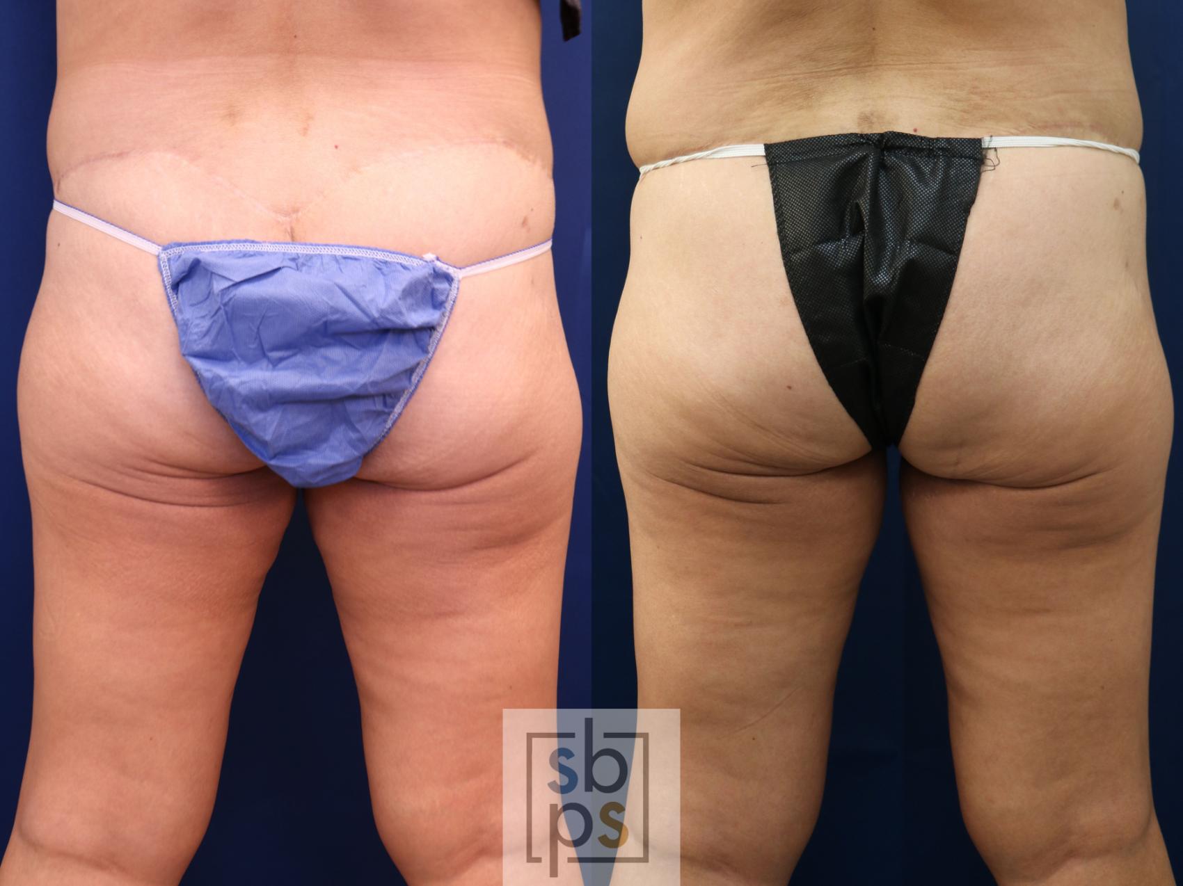 Before & After Thigh Lift Case 756 Back View in Los Angeles, Torrance & Long Beach, CA