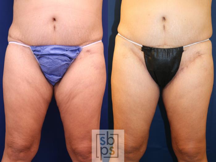 Before & After Thigh Lift Case 756 Front View in Los Angeles, Torrance & Long Beach, CA