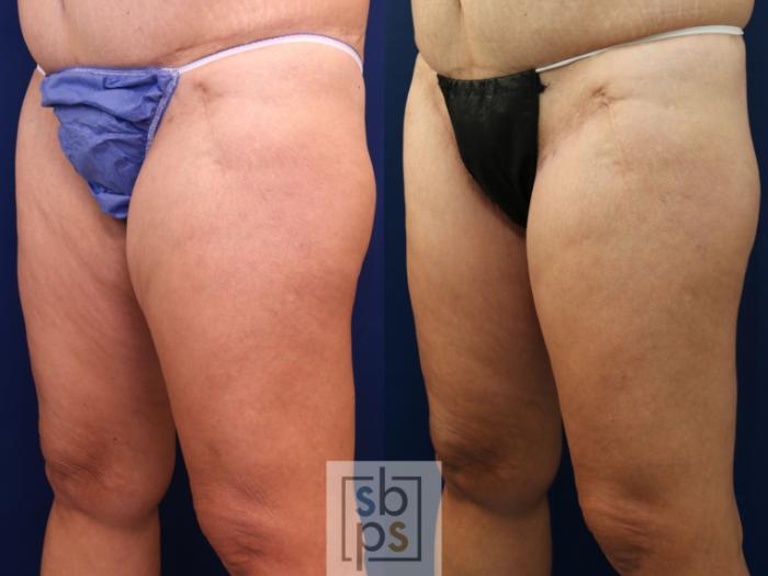 Before & After Thigh Lift Case 756 Left Oblique View in Los Angeles, Torrance & Long Beach, CA