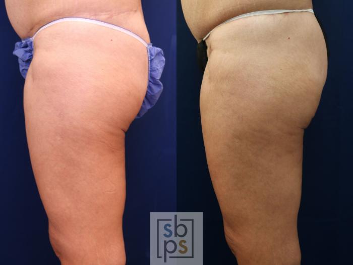 Before & After Thigh Lift Case 756 Left Side View in Los Angeles, Torrance & Long Beach, CA