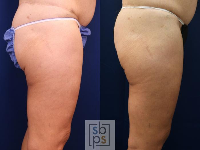 Before & After Thigh Lift Case 756 Right Side View in Los Angeles, Torrance & Long Beach, CA