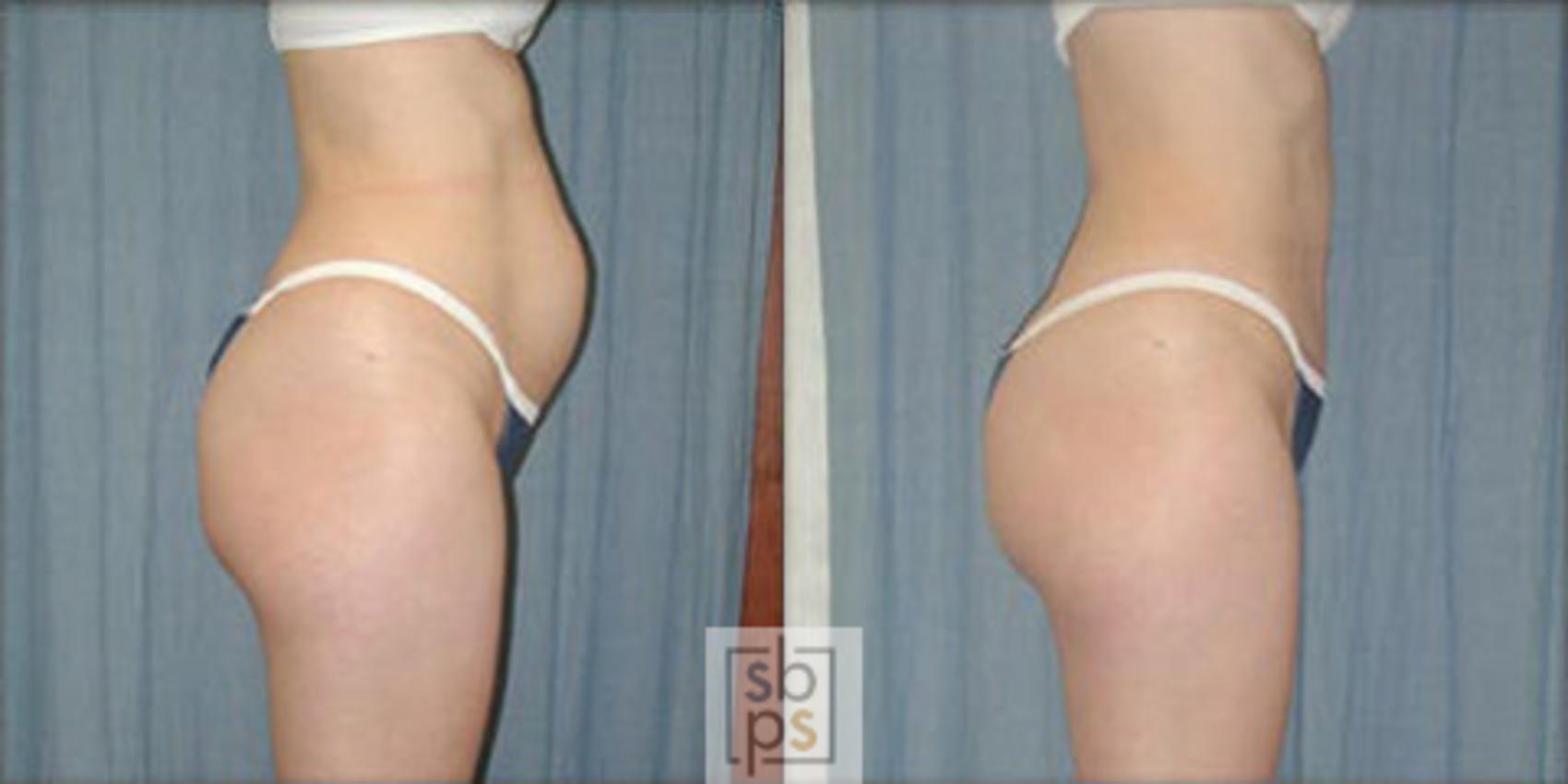 Before & After Tummy Tuck Case 1 View #1 View in Torrance, CA