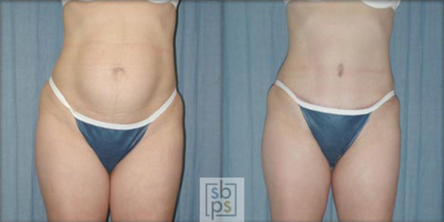 Before & After Tummy Tuck Case 1 View #2 View in Torrance & Los Angeles, CA, CA