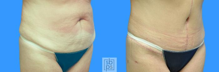 Before & After Tummy Tuck Case 100 View #10 View in Torrance, CA