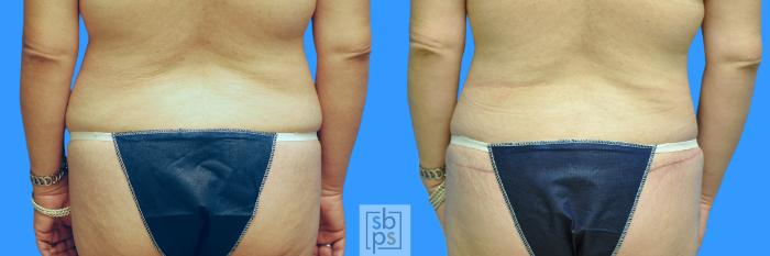Before & After Tummy Tuck Case 100 View #12 View in Torrance, CA