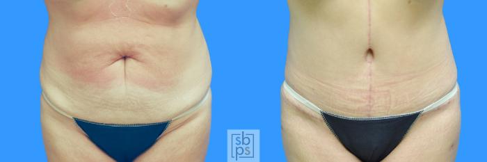 Before & After Tummy Tuck Case 100 View #7 View in Torrance, CA