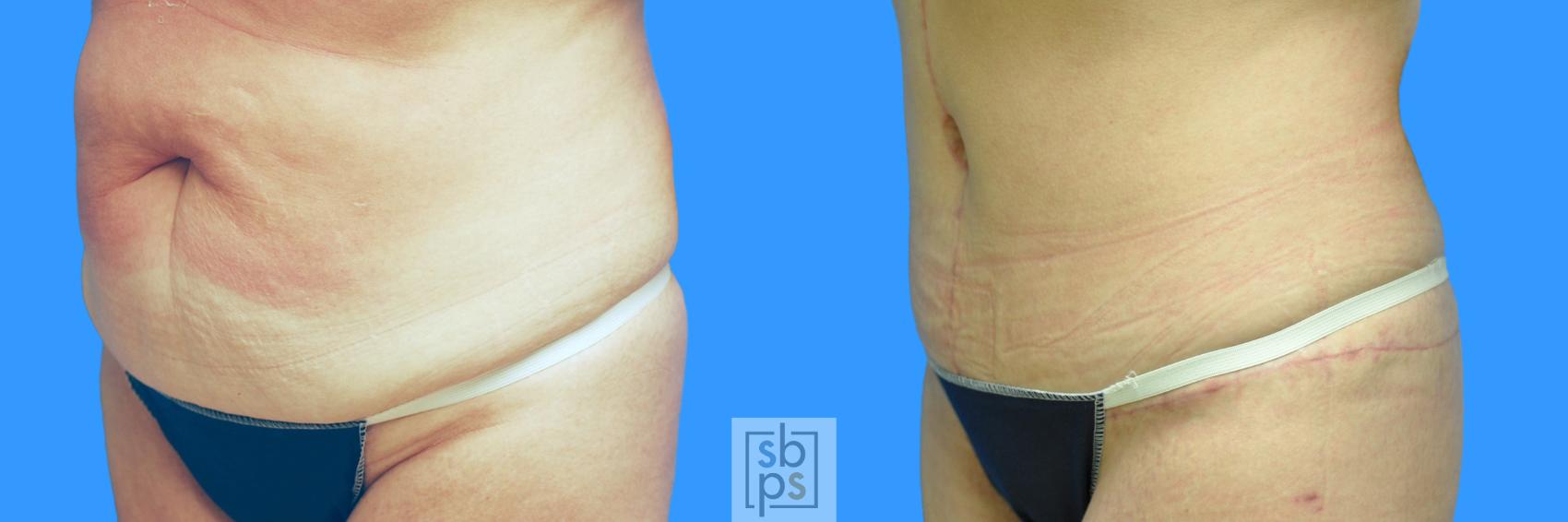 Before & After Tummy Tuck Case 100 View #9 View in Torrance & Los Angeles, CA, CA