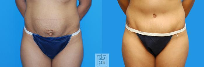 Before & After Tummy Tuck Case 127 View #1 View in Torrance, CA