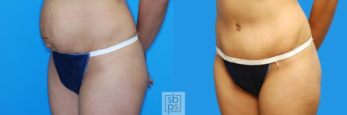Before & After Tummy Tuck Case 127 View #2 View in Torrance, CA