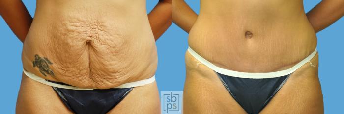 Before & After Tummy Tuck Case 128 View #1 View in Torrance, CA