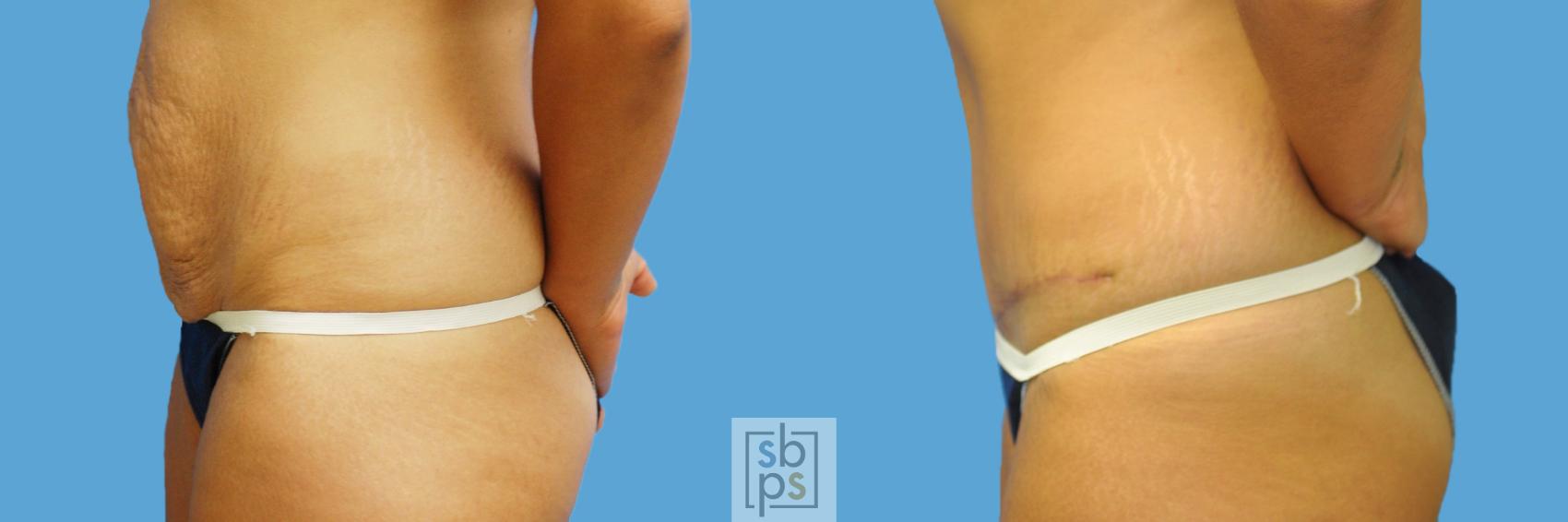 Before & After Tummy Tuck Case 128 View #2 View in Los Angeles, Torrance & Long Beach, CA