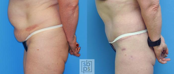 Before & After After Massive Weight Loss Case 177 View #2 View in Torrance, CA