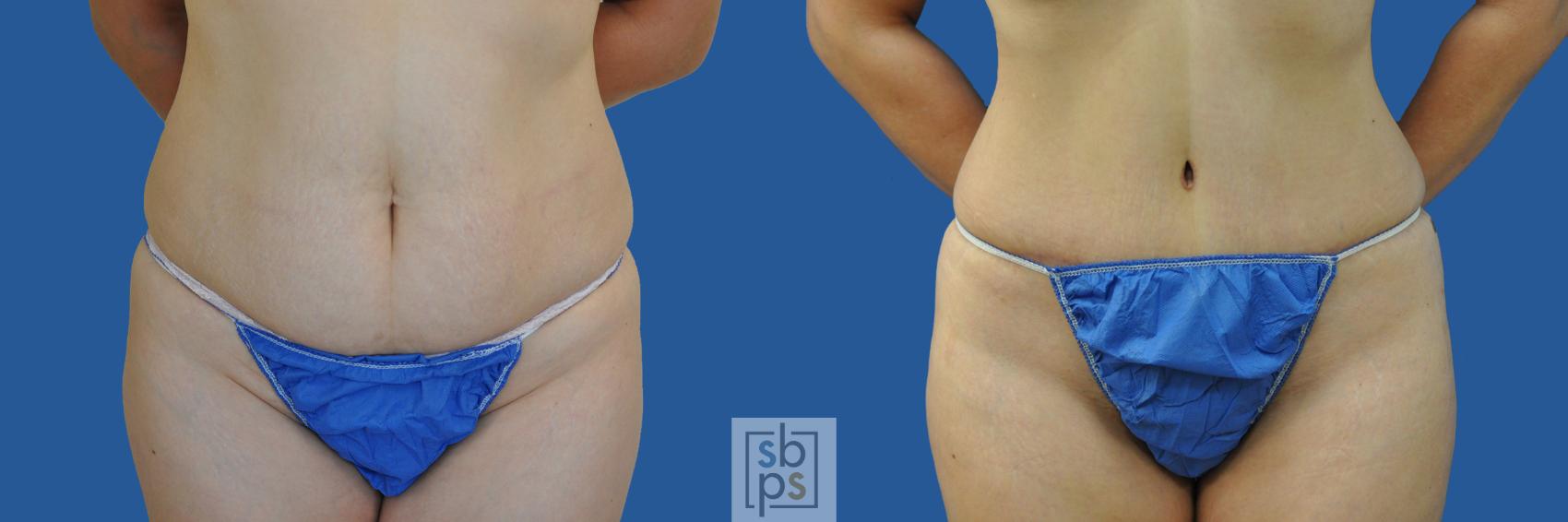 Before & After Tummy Tuck Case 190 View #1 View in Torrance, CA