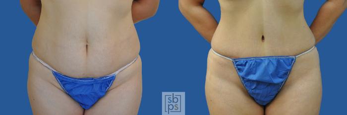 Before & After Tummy Tuck Case 190 View #1 View in Torrance, CA