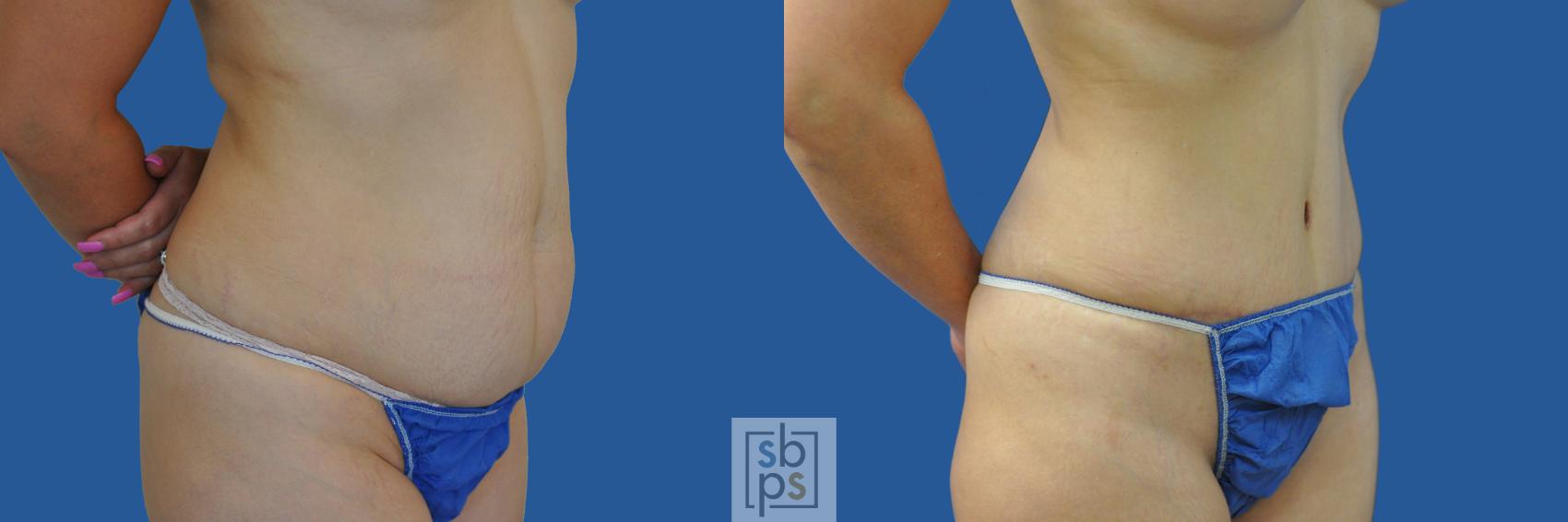 Before & After Tummy Tuck Case 190 View #2 View in Torrance & Los Angeles, CA, CA