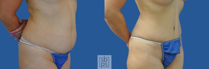 Before & After Tummy Tuck Case 190 View #2 View in Torrance, CA