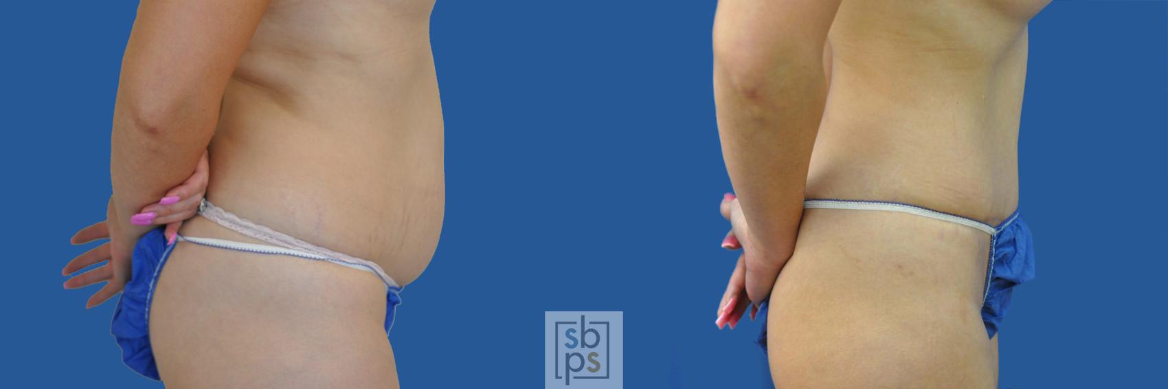 Before & After Tummy Tuck Case 190 View #3 View in Torrance & Los Angeles, CA, CA