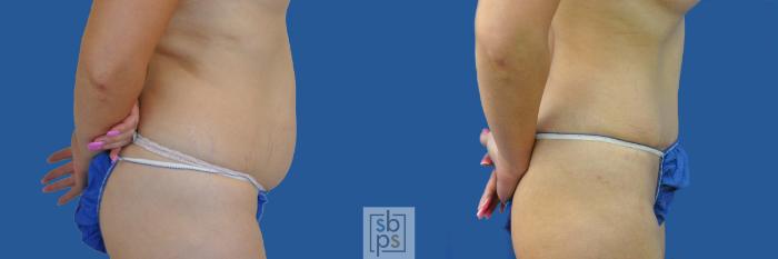 Before & After Tummy Tuck Case 190 View #3 View in Torrance, CA
