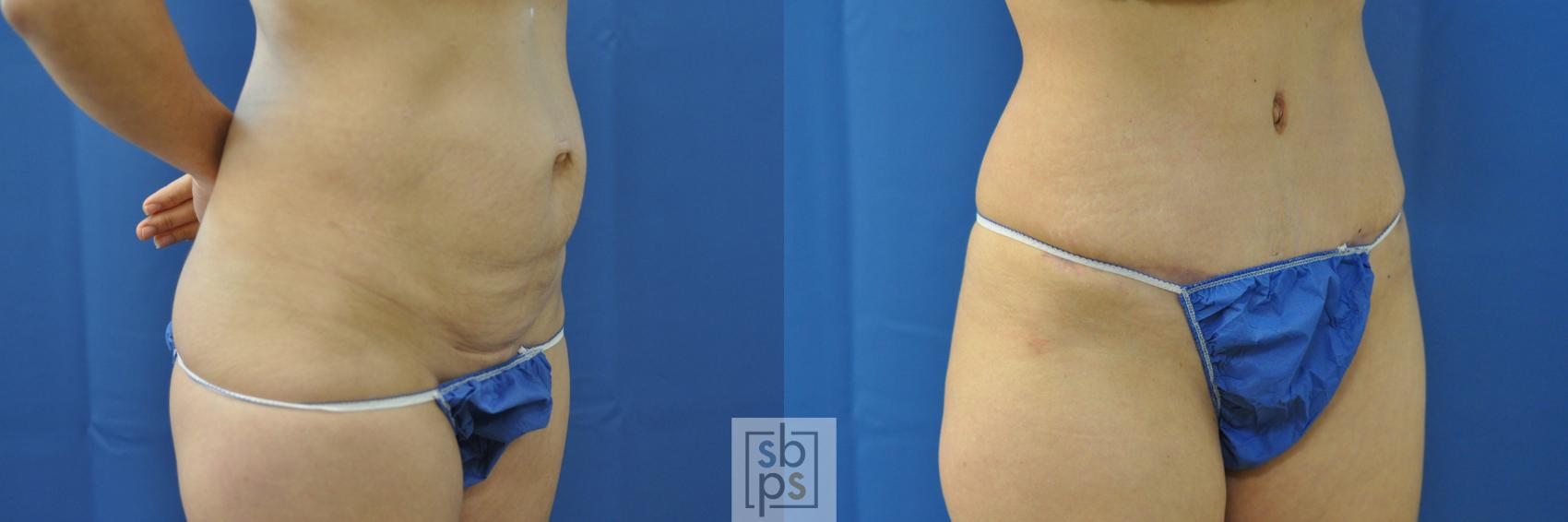 Before & After Tummy Tuck Case 206 View #1 View in Torrance, CA