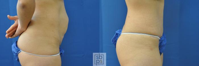 Before & After Tummy Tuck Case 206 View #2 View in Torrance, CA