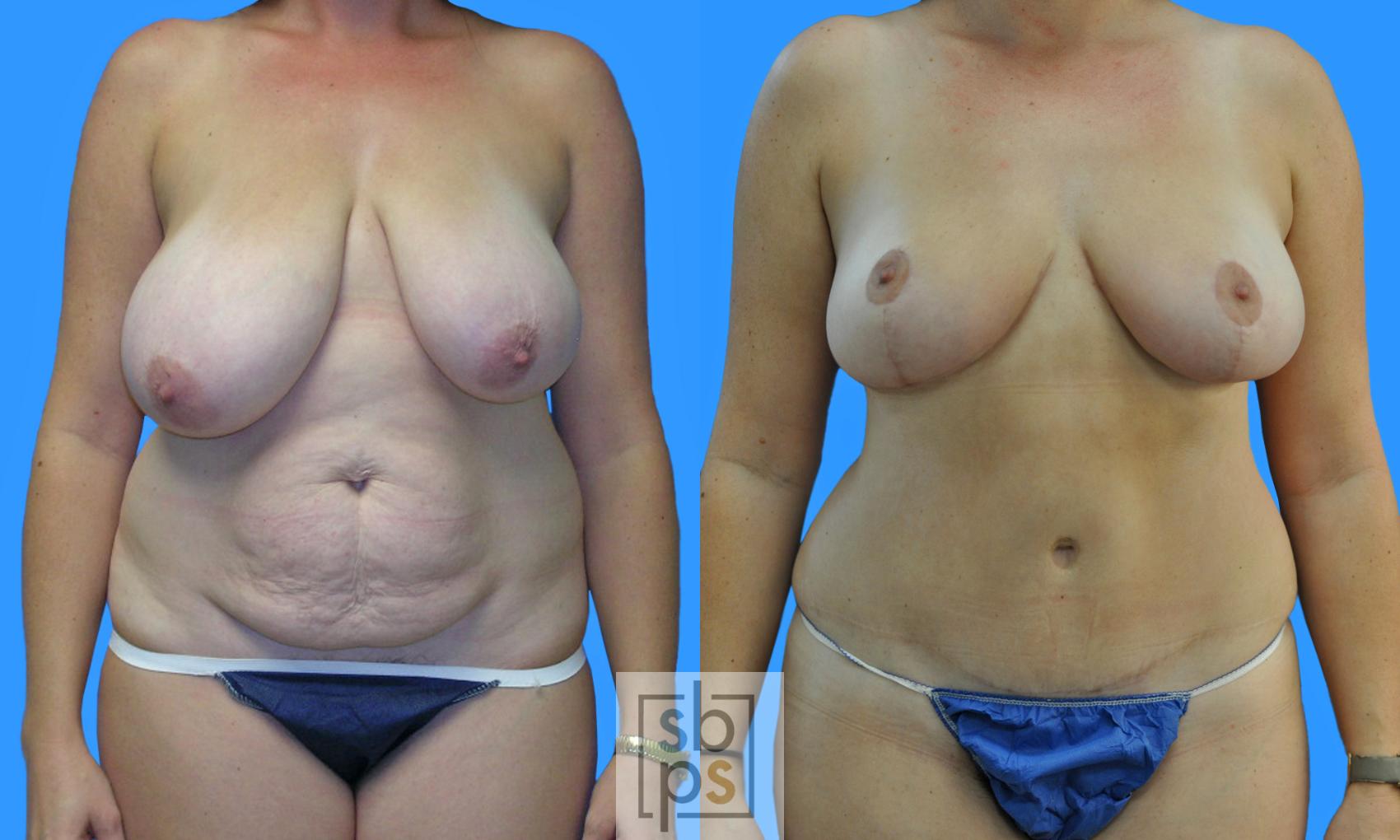 Before & After Breast Reduction Case 218 View #1 View in Torrance, CA