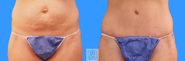 Before & After Tummy Tuck Case 224 View #1 View in Torrance, CA