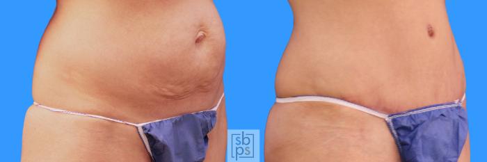 Before & After Tummy Tuck Case 224 View #2 View in Torrance, CA